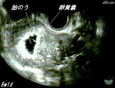 妊娠初期　胎のう 卵黄嚢